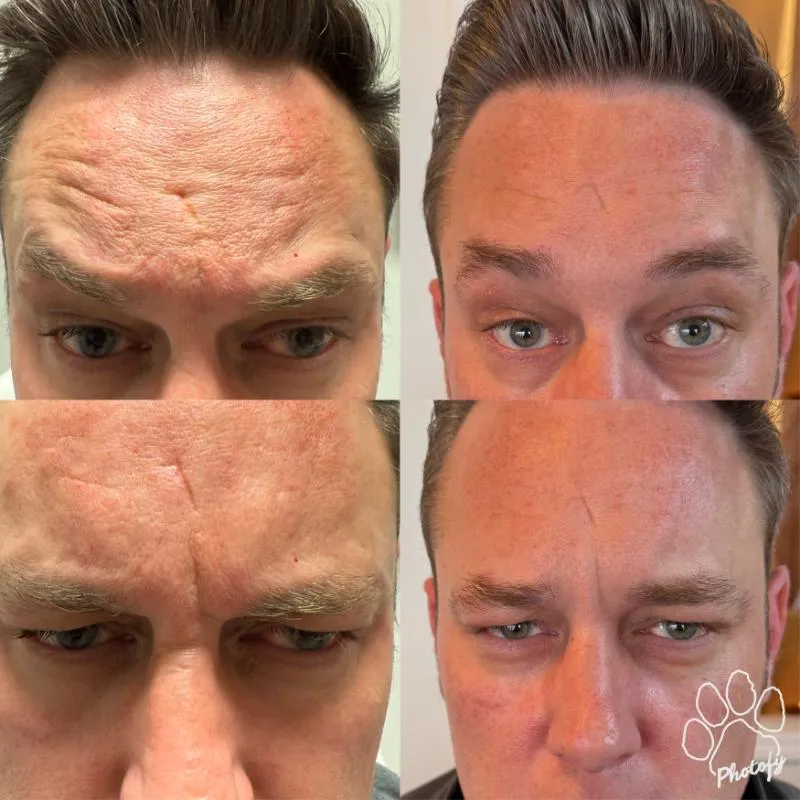 Four-panel before-and-after photograph of an adult patient's forehead and brow, shown front-on in two upper and two lower frames.