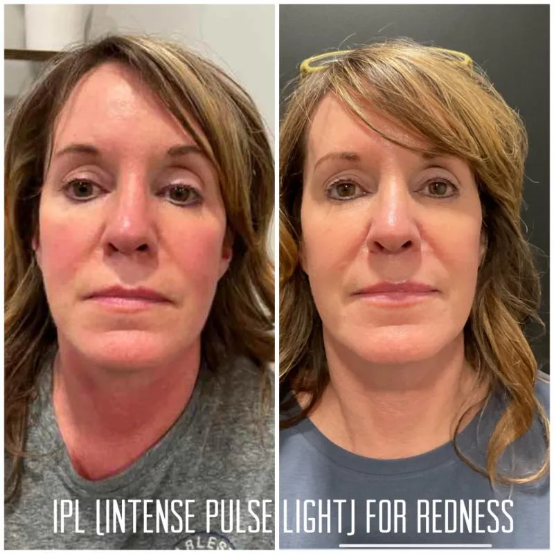 Two-panel photograph, side by side, of a patient's face and neck viewed front-on, with the caption IPL (Intense Pulse Light) for Redness across the lower edge.