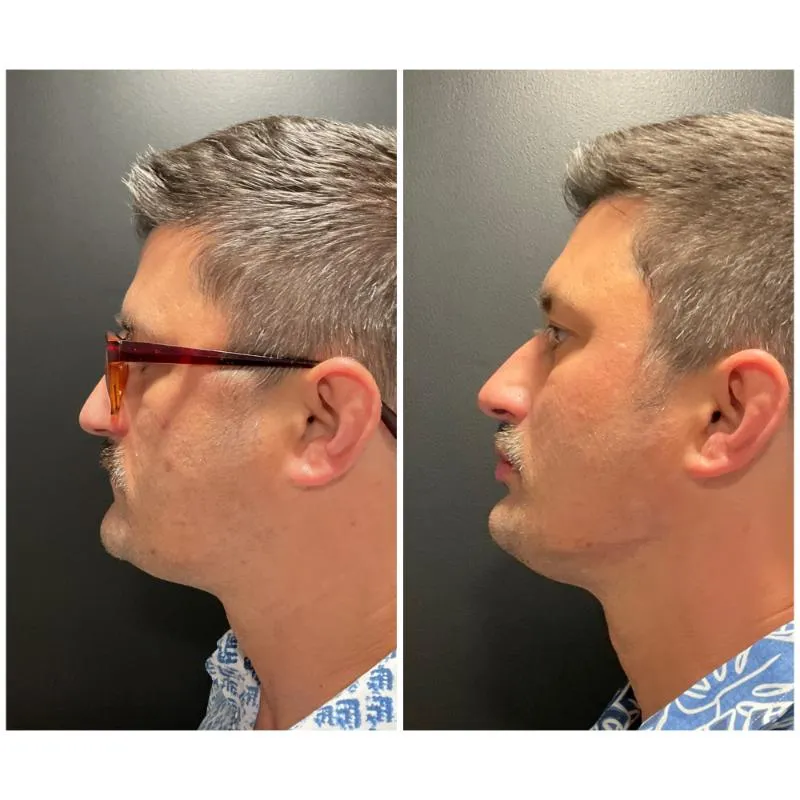 Two-panel before-and-after photograph of an adult patient's jawline and chin, shown in left side profile.
