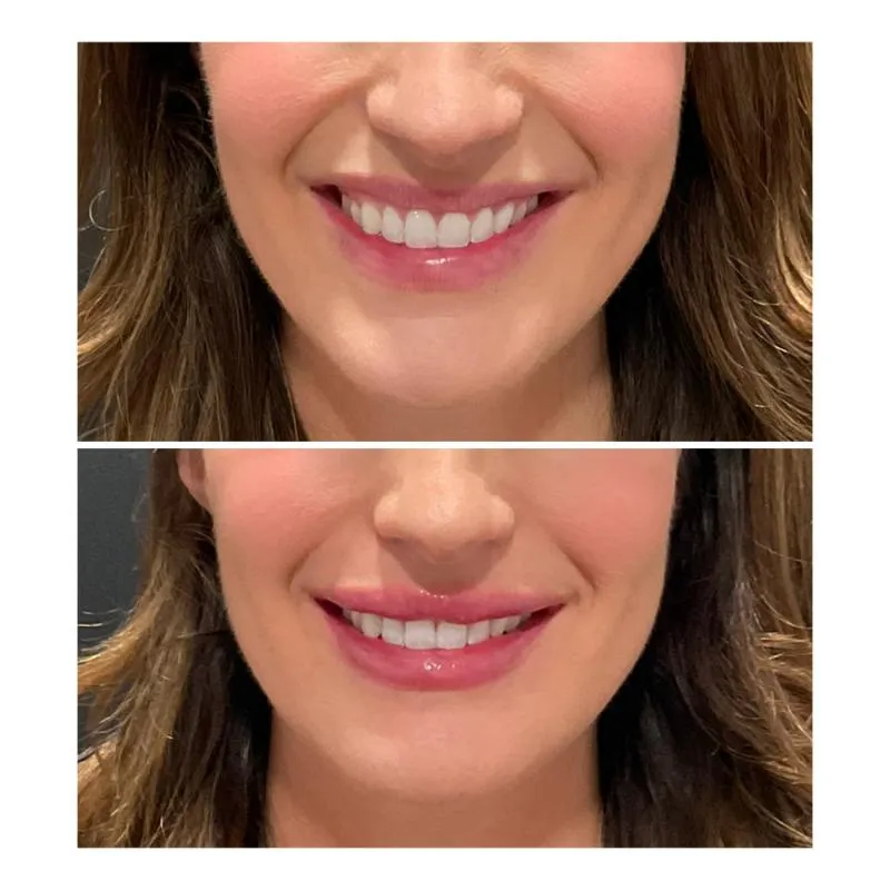 Two-panel before-and-after photograph, stacked vertically, of a patient's lower face while smiling.