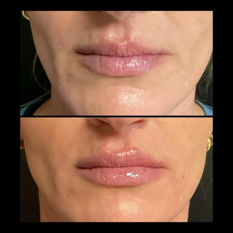 Two-panel before-and-after photograph, stacked vertically, of a patient's lips and chin viewed front-on.