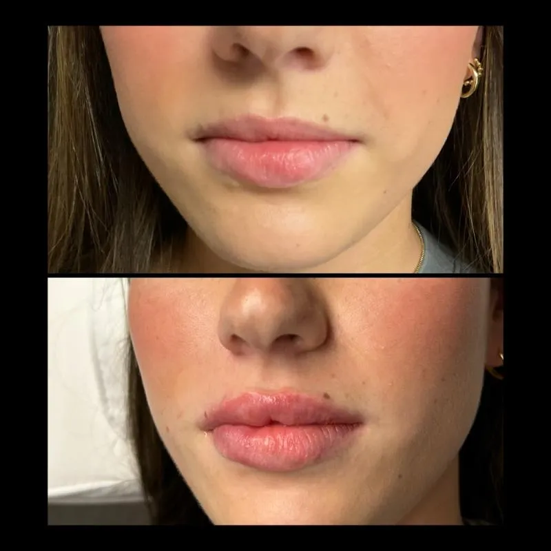 Two-panel before-and-after photograph, stacked vertically, of a patient's nose, lips and chin viewed front-on.