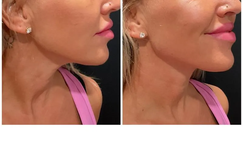 Two-panel before-and-after photograph, side by side, of a patient's lower face and jawline in three-quarter profile.