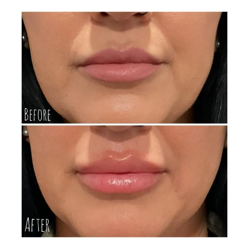 Two-panel photograph whose panels are labelled “Before” and “After”, stacked vertically, showing a close-up of a patient's lips and chin.