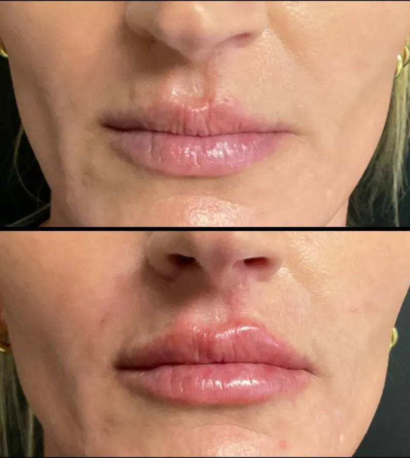 Two-panel before-and-after photograph, stacked vertically, of a patient's nose, lips and chin viewed front-on.