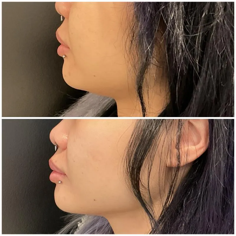 Two-panel before-and-after photograph, stacked vertically, of a patient's lips and lower face in side profile.