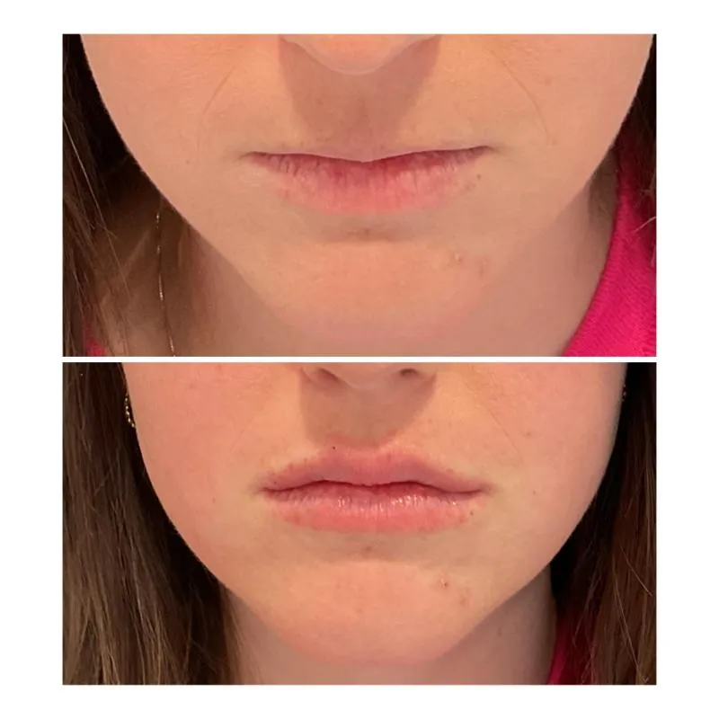 Two-panel before-and-after photograph, stacked vertically, of a close-up of a patient's lips and chin.