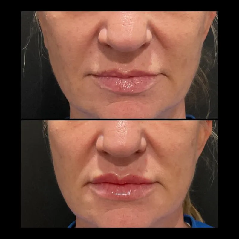 Two-panel before-and-after photograph, stacked vertically, of a patient's lower face from nose to chin, viewed front-on.
