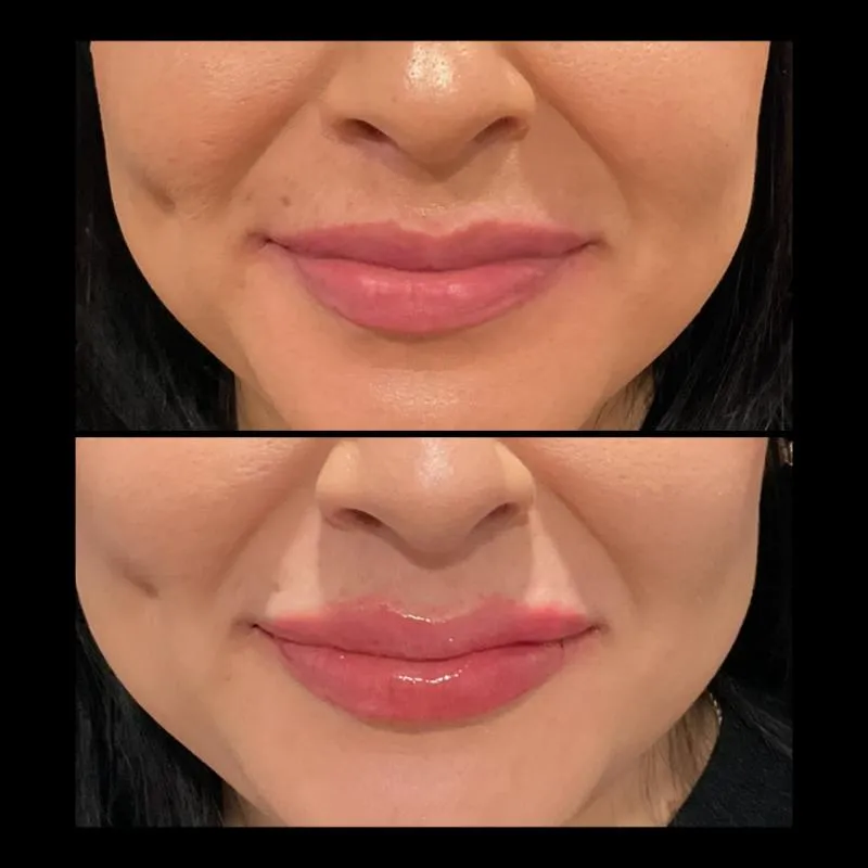 Two-panel before-and-after photograph, stacked vertically, of a close-up of a patient's lips and chin.