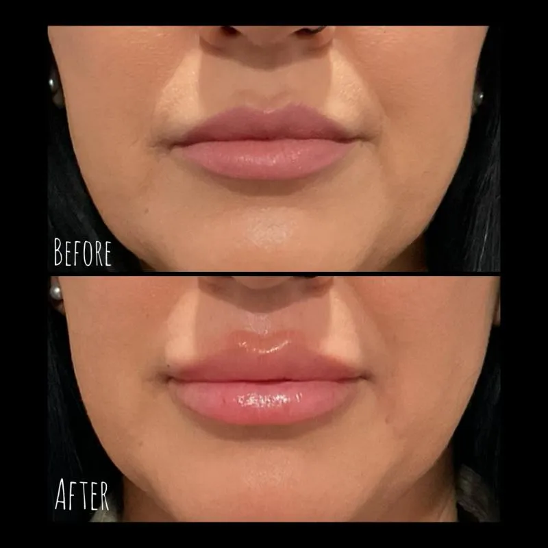 Two-panel photograph whose panels are labelled “Before” and “After”, stacked vertically, showing a close-up of a patient's lips and chin.