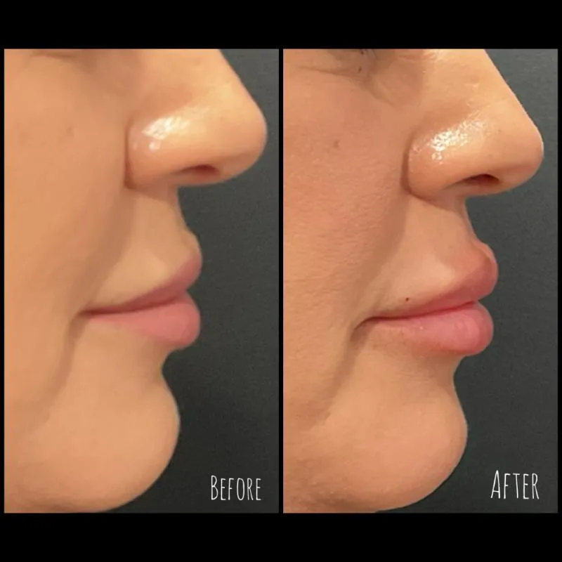 Two-panel photograph whose panels are labelled “Before” and “After”, side by side on a dark background, showing a patient's nose, lips and chin in side profile.