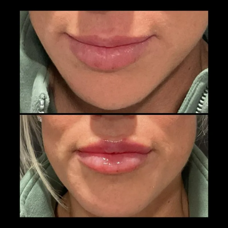 Two-panel before-and-after photograph, stacked vertically, of a patient's lips and chin viewed front-on.