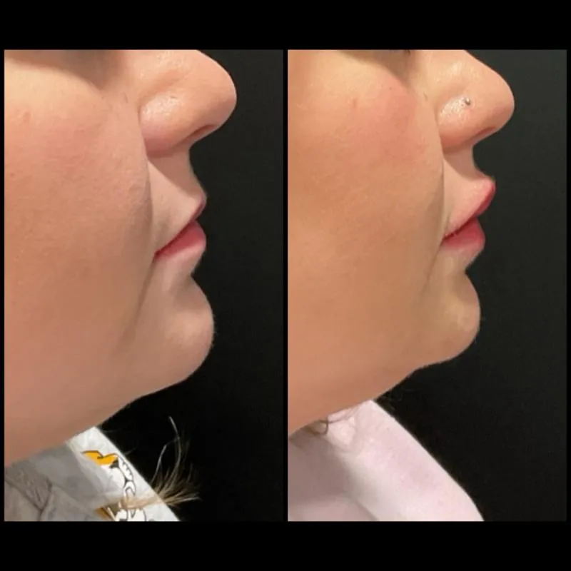 Two-panel before-and-after photograph, side by side, of a patient's lips, lower face and jawline in side profile.