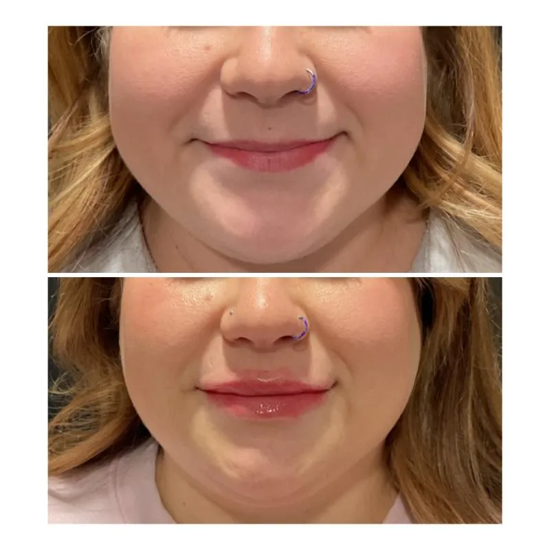 Two-panel before-and-after photograph, stacked vertically, of a patient's lower face and lips viewed front-on.