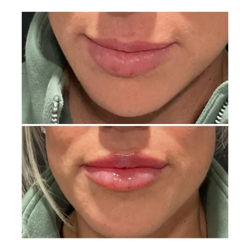 Two-panel before-and-after photograph, stacked vertically, of a close-up of a patient's lips and chin.
