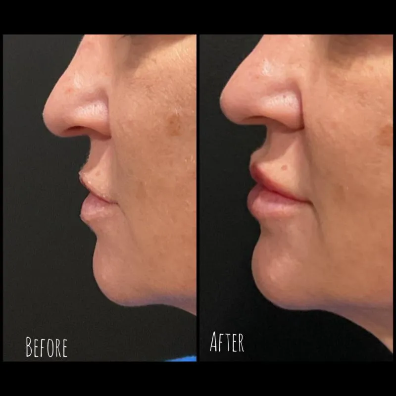 Two-panel photograph whose panels are labelled “Before” and “After”, side by side on a dark background, showing a patient's nose, lips and chin in side profile.