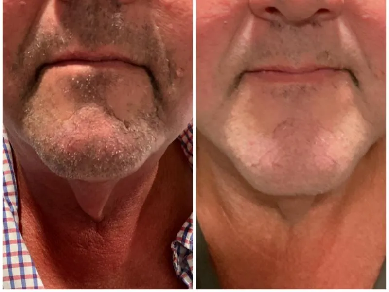 Two-panel before-and-after photograph, side by side, of a patient's chin, beard area and neck.
