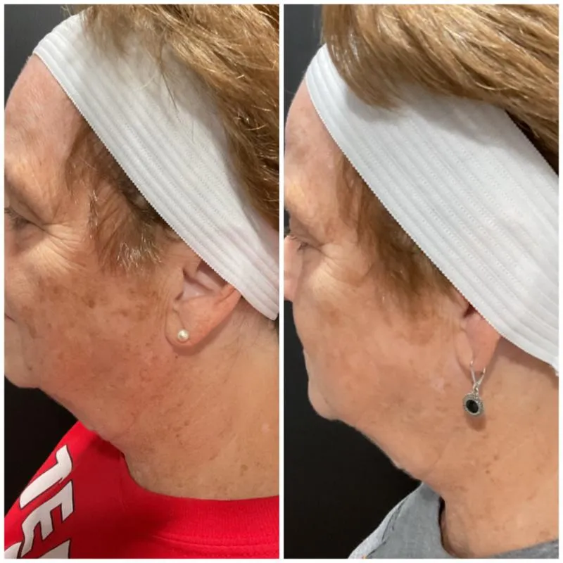 Two-panel before-and-after photograph, side by side, of a patient's cheek, ear and jaw in side view, hair held back by a headband.