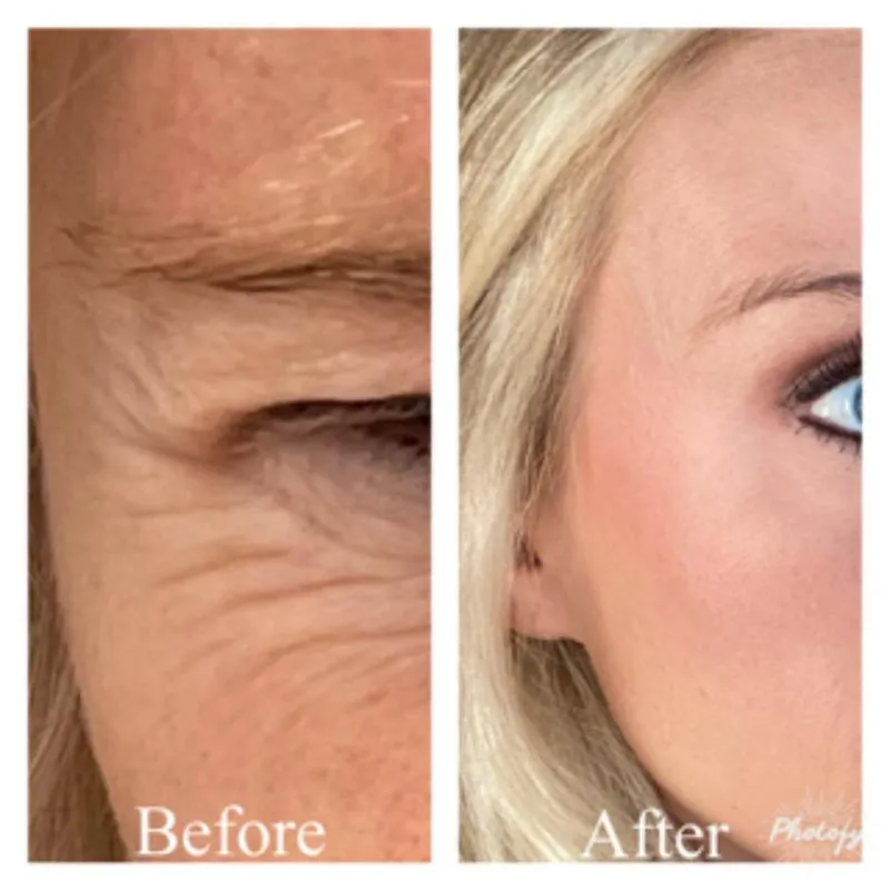 Two-panel photograph whose panels are labelled “Before” and “After”, side by side, showing a close-up of the outer corner of a patient's eye and temple.
