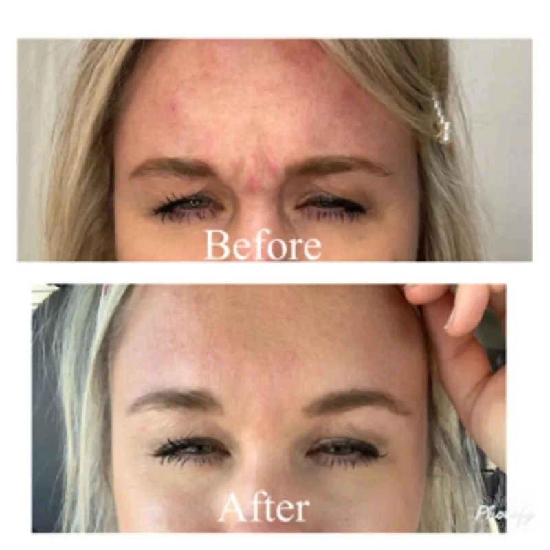 Two-panel photograph whose panels are labelled “Before” and “After”, stacked vertically, showing a patient's forehead, brow and eyes front-on.