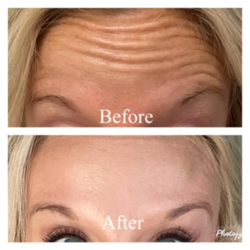 Two-panel photograph whose panels are labelled “Before” and “After”, stacked vertically, showing a patient's forehead and brow front-on.