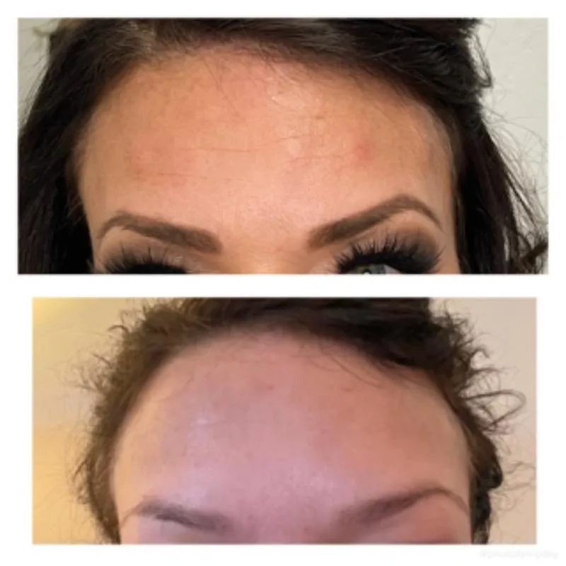 Two-panel before-and-after photograph, stacked vertically, of a patient's forehead and brow viewed front-on.