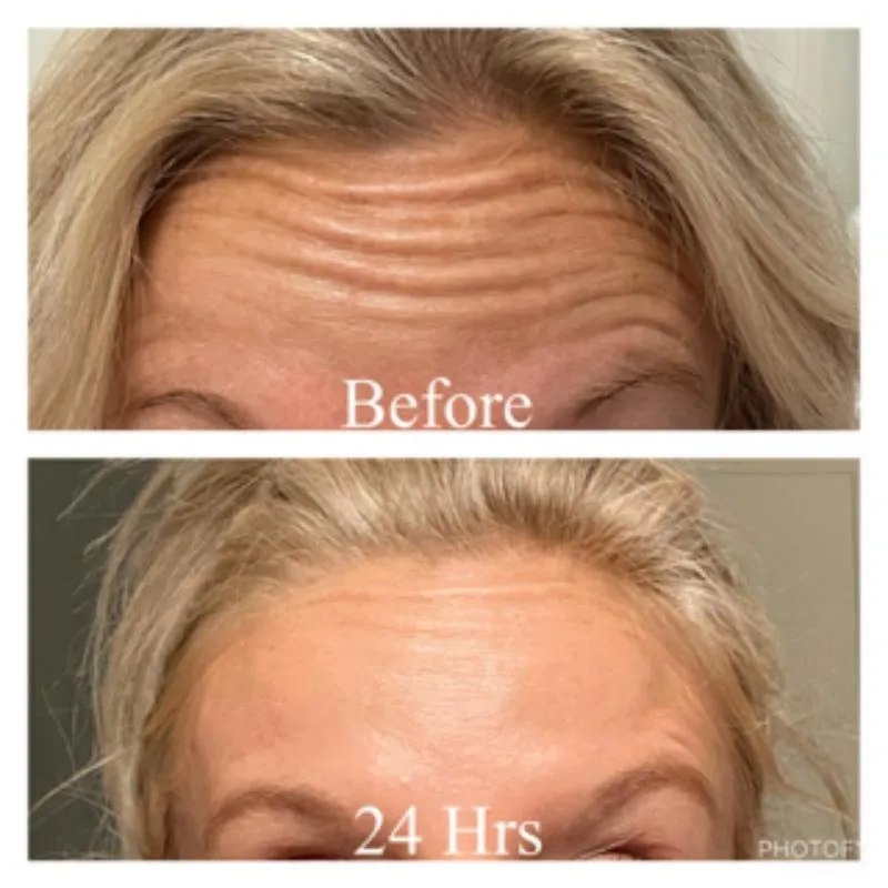 Two-panel photograph labelled Before and 24 Hrs, stacked vertically, showing a patient's forehead and brow front-on.