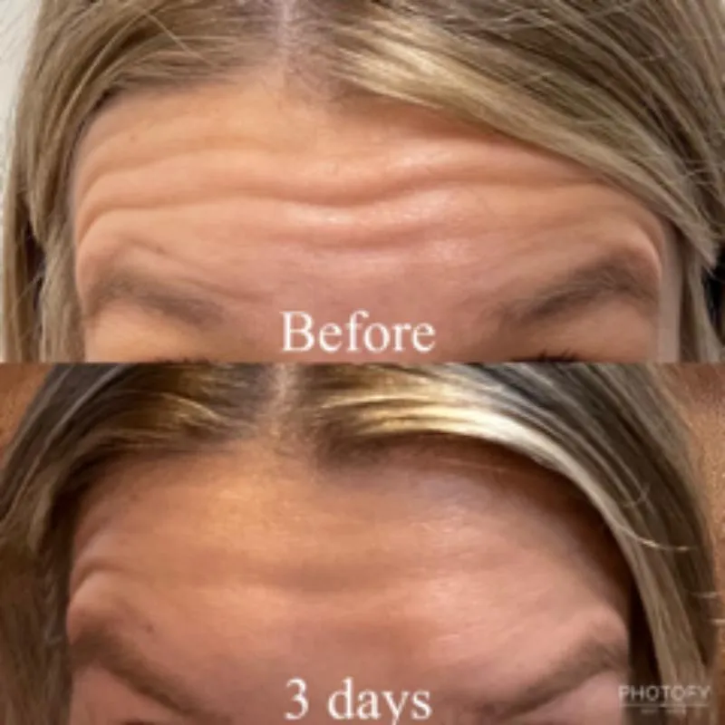 Two-panel photograph labelled Before and 3 days, stacked vertically, showing a patient's forehead and brow front-on.