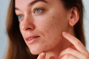 Woman showing acne spots during facial treatment