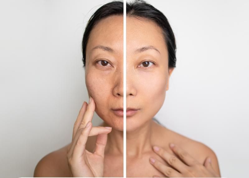 A portrait of a woman divided down the middle into two halves, the left half showing freckles and uneven texture and the right half showing even skin.