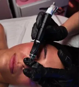 Hydrafacial device in action during a facial treatment.