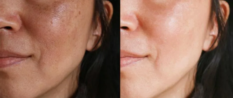 Side-by-side close-up photographs of the lower half of a woman’s face.