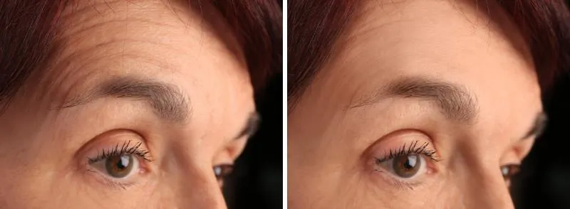 Side-by-side close-up photographs of a woman’s forehead and eye, with horizontal lines above the brow in the left frame and an unlined brow in the right.
