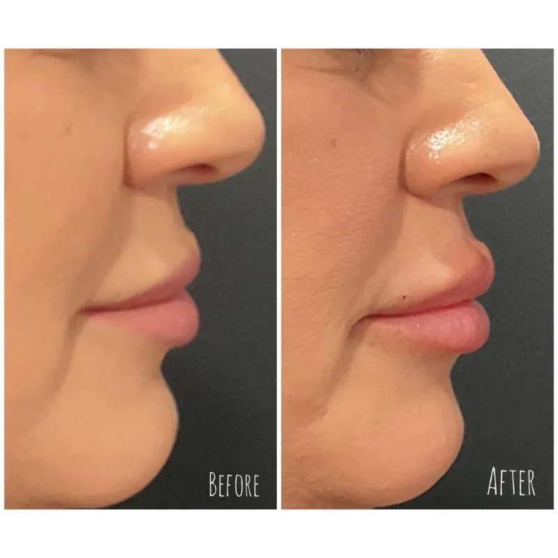 Two-panel photograph whose panels are labelled “Before” and “After”, side by side on a dark background, showing a patient's nose, lips and chin in side profile.