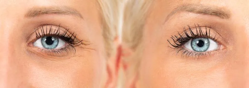 Side-by-side close-up photographs of a woman’s eyes, with fine lines at the outer corner in the left frame and none visible in the right.